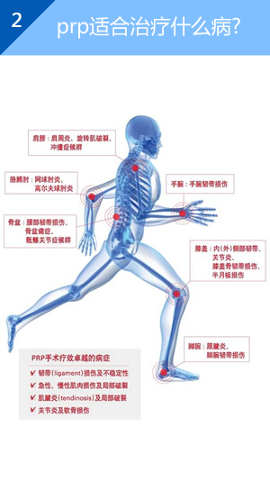 prp适合治疗什么关节病?