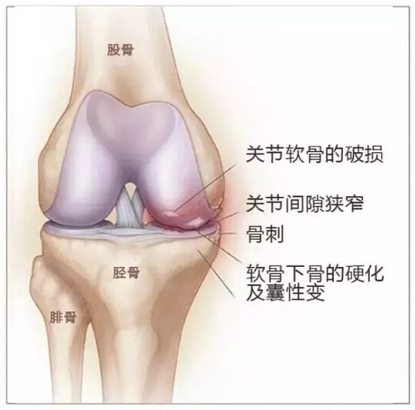 PRP治疗膝关节骨关节炎临床病例展示