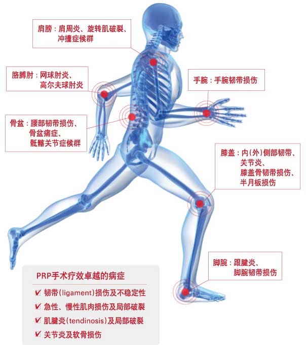 prp可以治疗什么关节疾病