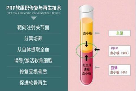 PRP促进骨质修复技术——加强骨性自我修复，恢复骨组织结构