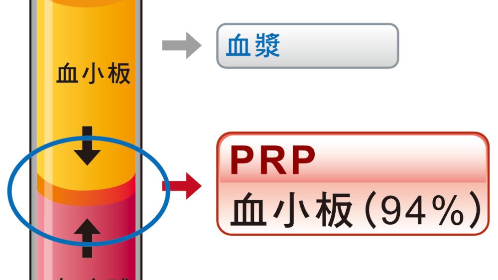 三军总医院澎湖分院骨科团队提供PRP治疗解决膝关节疼痛