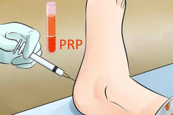 晒步数晒出足底筋膜炎，PRP帮你解决问题！