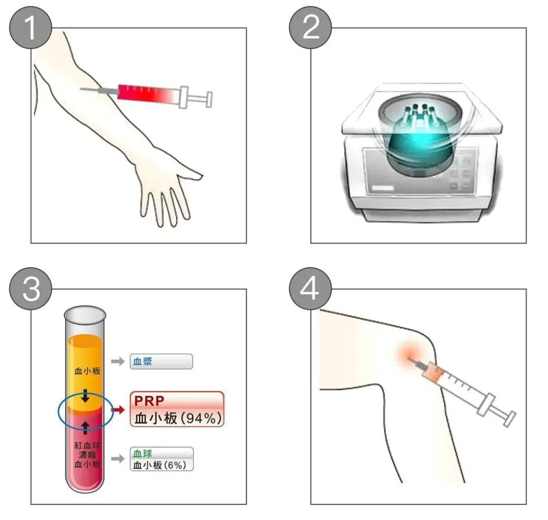 富血小板血浆PRP在运动医学运用及注意事项3.jpg