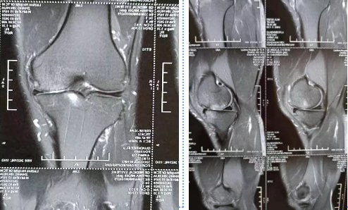 莱州市中医医院——膝关节镜微创技术辅以PRP治疗骨性关节炎