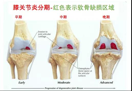 家有老人必看！膝盖疼痛千万别忍着，珍“膝”所有，健康护“膝”！