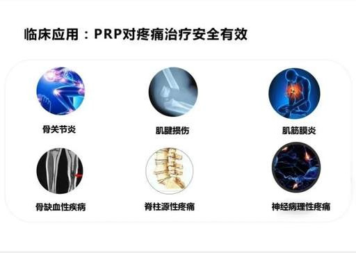 乾县人民医院：富血小板血浆（PRP），膝关节病患者的福音