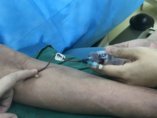 海南省人民医院首例富血小板血浆成功治疗膝骨性关节炎