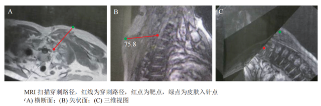 PRP疗法——治疗带状疱疹后神经痛的新希望6.png