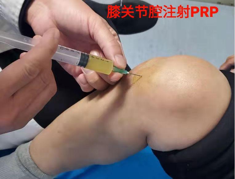 膝关节骨性关节炎的新疗法——富血小板血浆(PRP)
