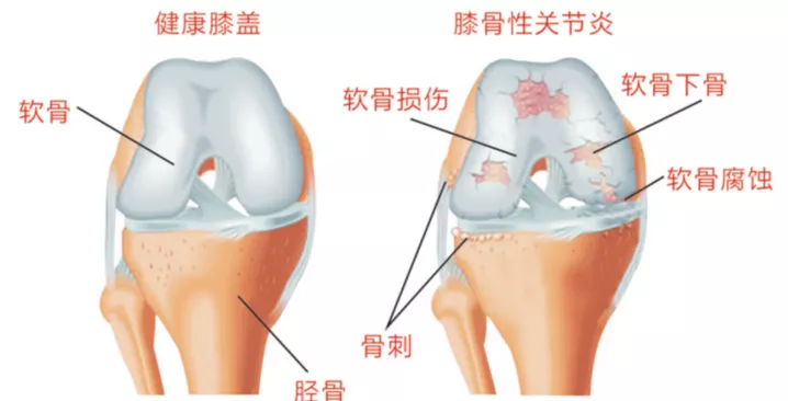 新疆中医医院关节外科：富血小板血浆(PRP)治疗骨关节炎