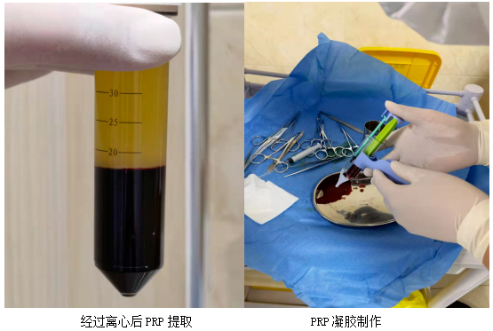 怒江州人民医院成功开展首例富血小板血浆PRP凝胶治疗技术