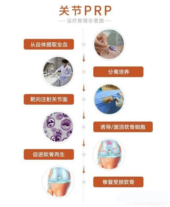 禹城市中医院开展的PRP治疗膝关节半月板损伤技术治疗效果好
