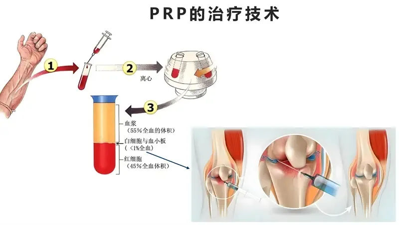 新乡卢氏骨科医院：PRP技术，骨关节炎患者的新“膝”望！
