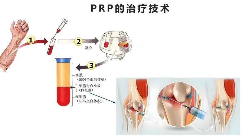 长春仲德骨科医院：PRP疗法，用自己的血液治疗自己的关节病