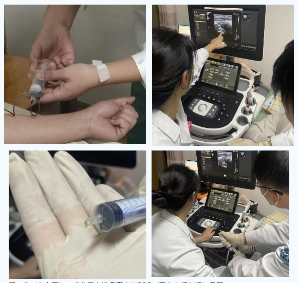 嵊泗县人民医院骨科成功开展一例B超引导下髋关节穿刺+囊肿减压+PRP（富血小板血浆）注射术