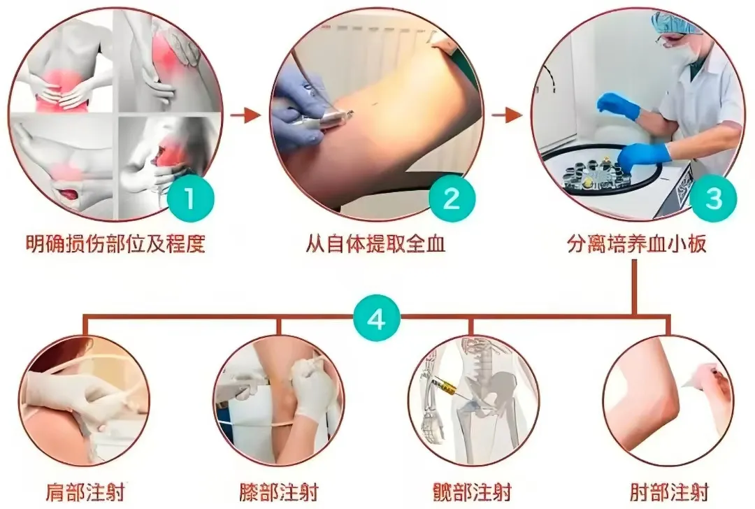 河间市人民医院：超声引导下PRP注射——再生修复组织治疗疼痛