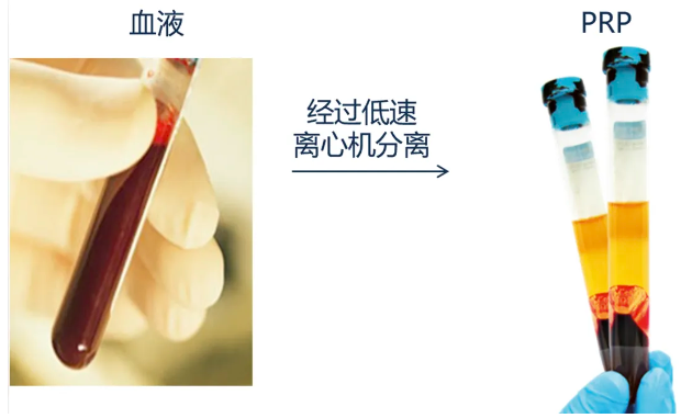 淮安曙光医院：富血小板血浆(PRP)，血液“自救”到底有多神奇？