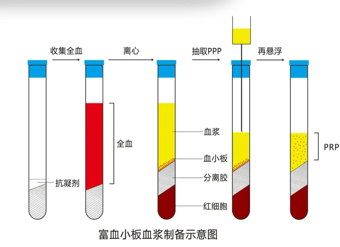 阳江市人民医院走进输血科系列报道③——PRP治疗新技术：开启个性化医疗新篇章