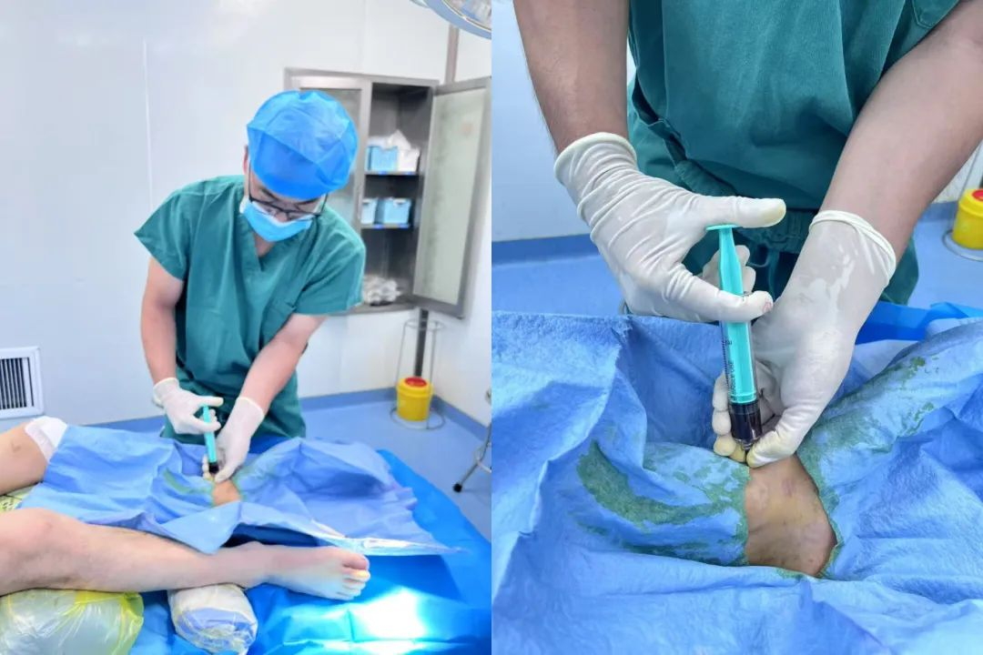曹县磐石医院骨科成功为一位双关节复杂损伤患者实施富血小板血浆（PRP）注射治疗