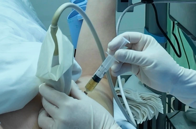 中南大学湘雅二医院：肩膝疼痛、活动受限，男子三次跨洋飞回长沙注射PRP！该疗法还有哪些妙用？