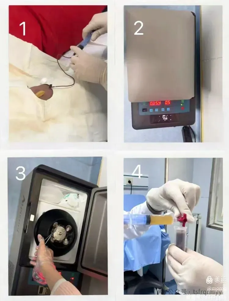 唐山市丰润区人民医院：PRP治疗为带状疱疹神经痛患者带来新希望