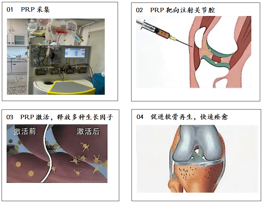 唤醒身体自愈力，濮阳市人民医院开展PRP治疗，为组织修复按下“加速键”！
