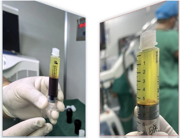 柳州市柳江区中医医院开展新技术——富血小板血浆（PRP）疗法